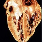 Heart_pathology_Chagas_disease