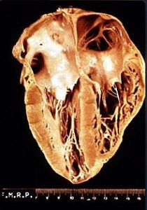 Heart_pathology_Chagas_disease Heart_pathology_Chagas_disease